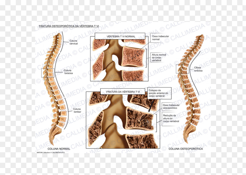 Fracture Osteoporosis Bone Vertebral Column Compression PNG