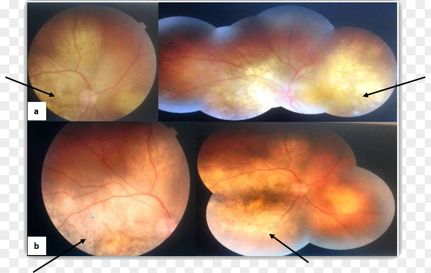 Eye Choroid Metastasis Fundus Extended-spectrum Penicillin PNG