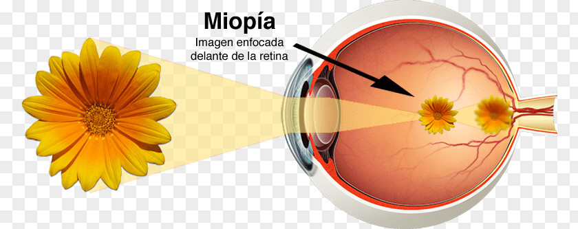 Miopia Human Eye Astigmatism Near-sightedness Far-sightedness PNG