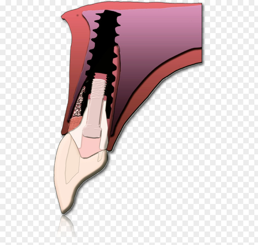 Implant Cartoon Jaw Shoe PNG