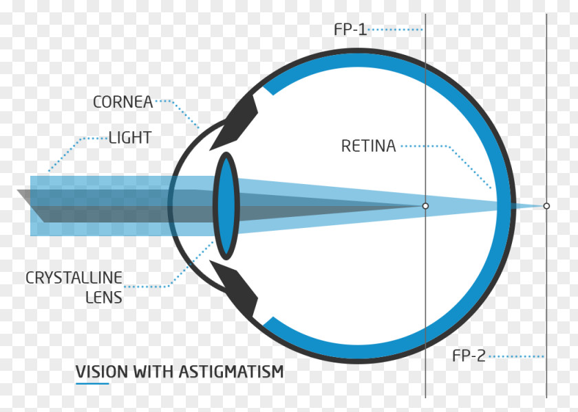 Eye Test Floater Presbyopia Visual Perception Nd:YAG Laser PNG