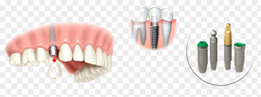 Crown Dental Implant Dentistry Tooth Implantology PNG