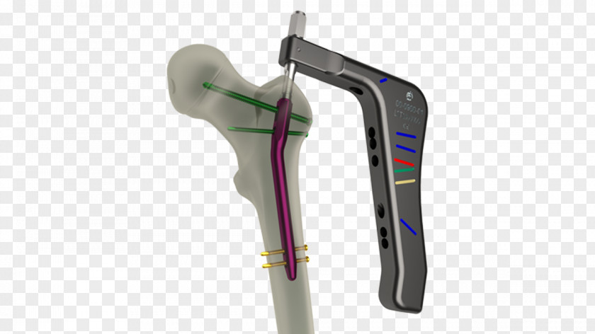 Fractures Femur Intramedullary Rod Femoral Fracture Hip Anatomy PNG