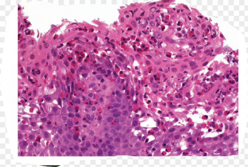 Eosinophilic Esophagitis Esophagus Dysphagia PNG