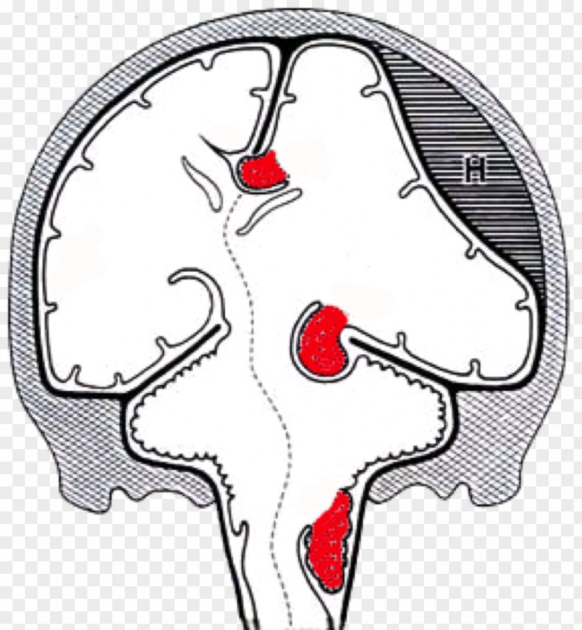 Brain Herniation Intracranial Pressure Uncus PNG