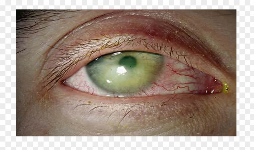 Eyelids Iris Dry Eye Syndrome Corneal Abrasion PNG