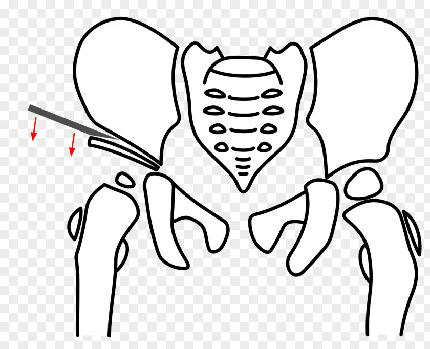 Pelvic Osteotomy Pelvis Triple-Osteotomie Hip Dysplasia Acetabulum PNG