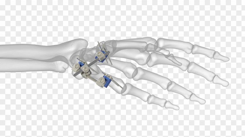 Thumb Ortho-aktiv Medizintechnik GmbH External Fixation Distal Radius Fracture Bone PNG