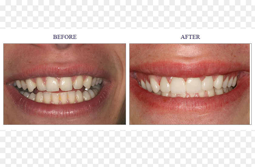 Crown Tooth Veneer Cosmetic Dentistry PNG
