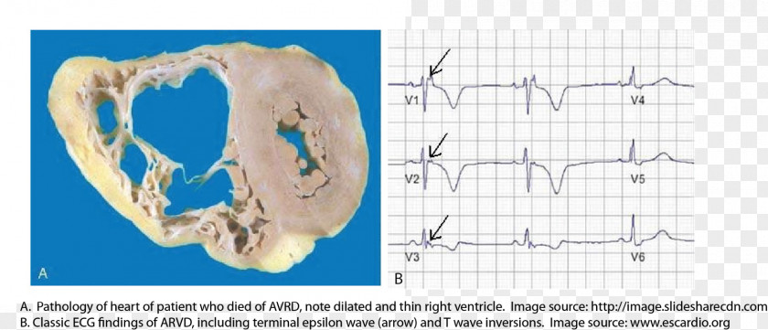 Heart Arrhythmogenic Right Ventricular Dysplasia Hypertrophic Cardiomyopathy Dilated Naxos Syndrome PNG