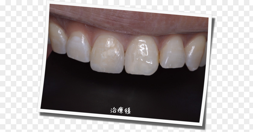 Dental Postcard Tooth Whitening 審美歯科 Braces Mouthguard PNG