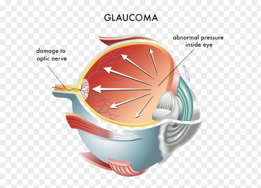 Eye Intraocular Pressure Glaucoma Ocular Hypertension Optic Nerve PNG