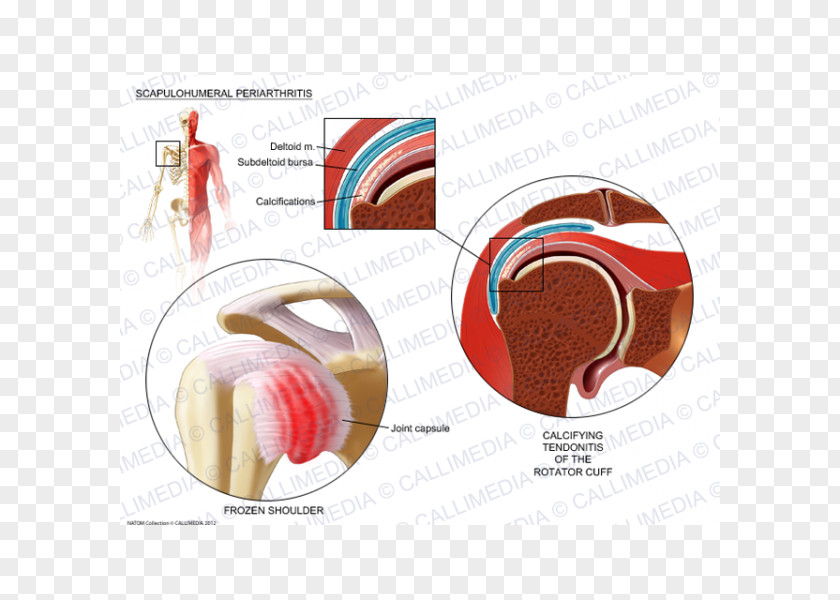 Endocrine System Shoulder Periarthritis Periartrite Scapolo-omerale Rheumatology PNG