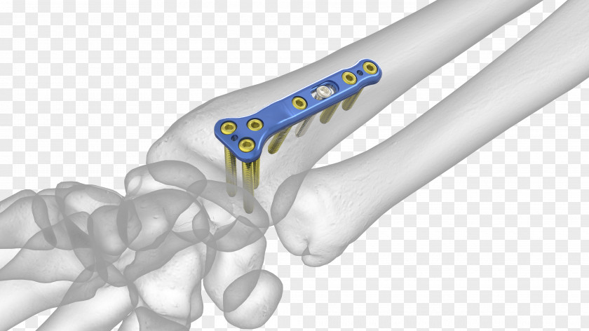 Bone Grafting Lunate Distal Radius Fracture Radial Styloid Process PNG