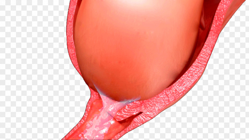 Cervical Mucus Plug Canal Cervix Blood PNG