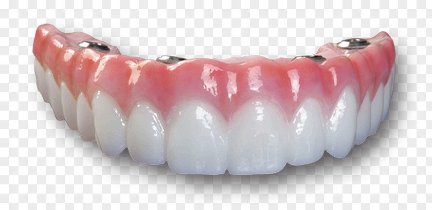 Dental Implants Implant Bridge Dentures Dentistry All-on-4 PNG