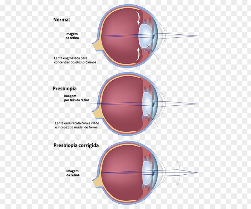 CLINICA Presbyopia Progressive Lens Ophthalmology Near-sightedness PNG