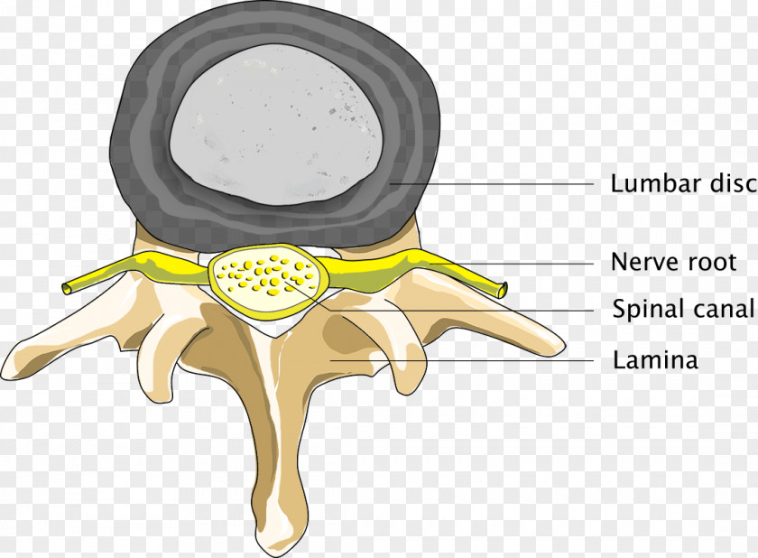 Spinal Back Disc Herniation Pain Stenosis Medical Diagnosis Vertebral Column PNG