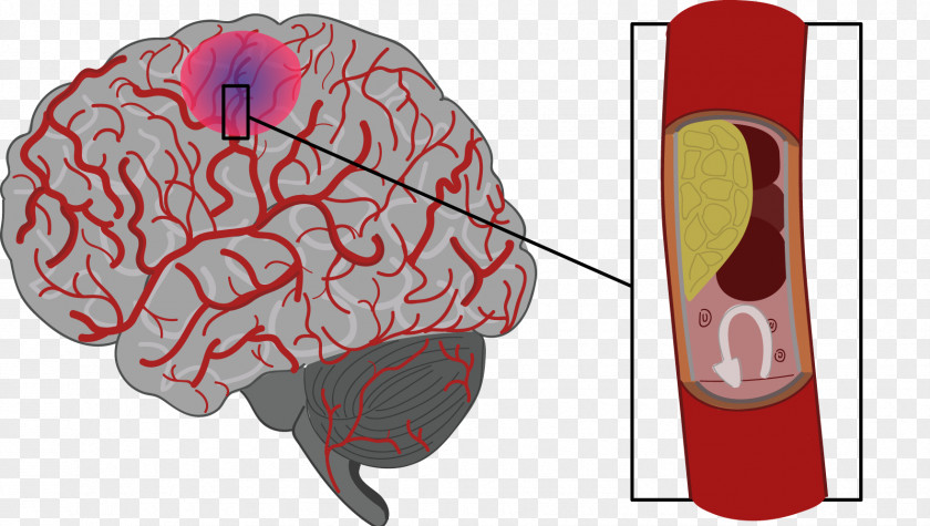 Gingival Bleeding Stroke Brain Haemorrhage Agy Risk Factor PNG