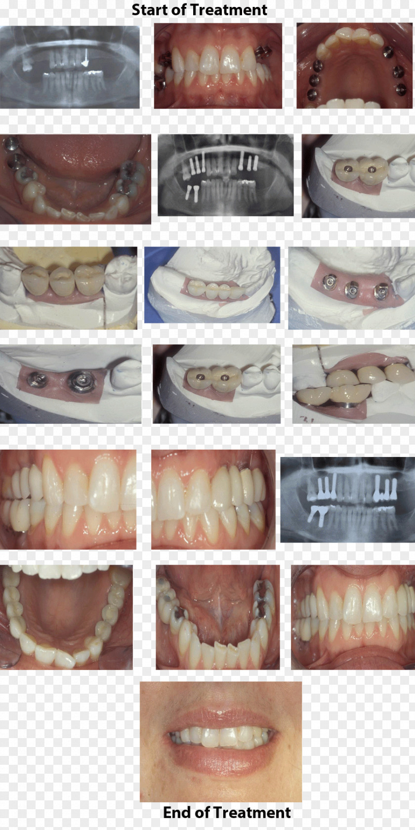 Bridge Kapshtica Renis DDS Dental Implant Tooth Dentistry PNG