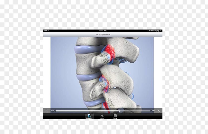 Facet Joint Injection Syndrome Pain PNG