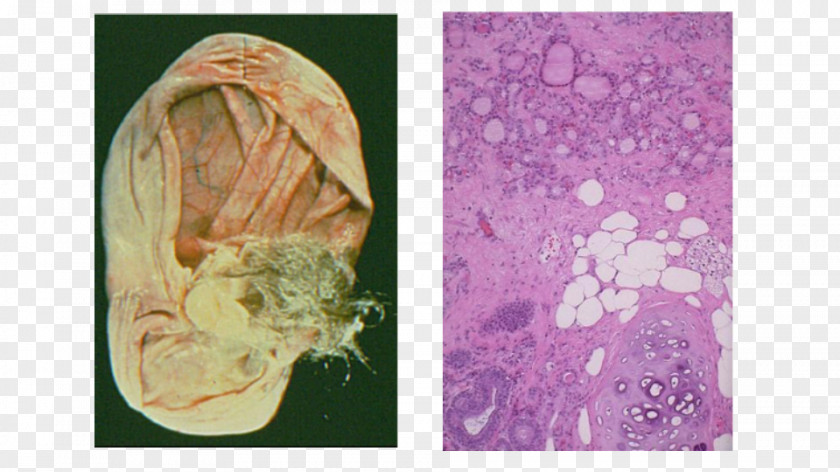 Cancer Cell Floral Design Paper Struma Ovarii Petal PNG