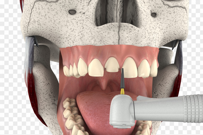 3d Tooth Veneer Cosmetic Dentistry Mouth Jaw PNG