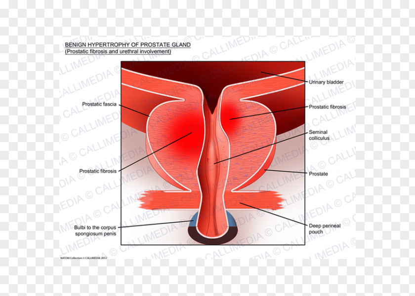 Benign Prostatic Hyperplasia Prostate Cancer Hypertrophy Tadalafil PNG