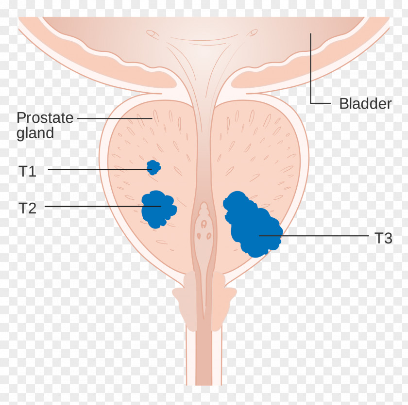 Prostate Cancer Surgery Prostate-specific Antigen PNG