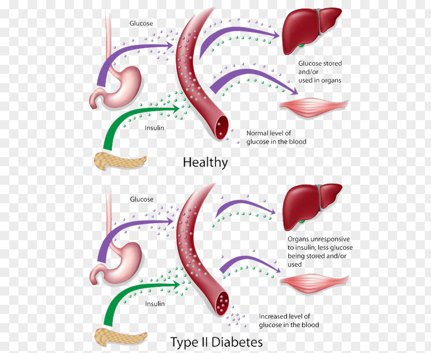Insulin Resistance Diabetes Mellitus Type 2 1 PNG