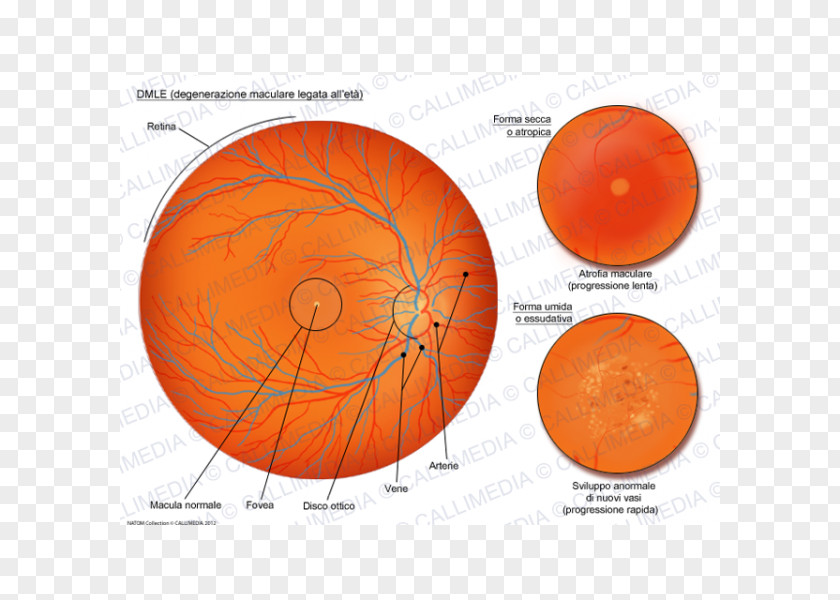 Eye Macular Degeneration Macula Of Retina Old Age Atrophy PNG