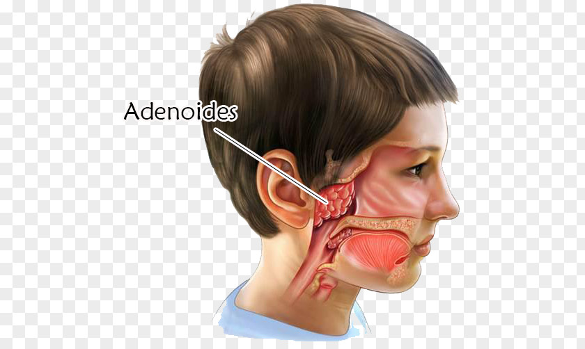 Nose Adenoid Tonsillectomy Surgery Tonsillitis PNG