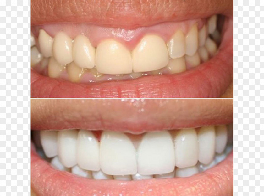 Crown Tooth Whitening Veneer Dental Porcelain Human PNG