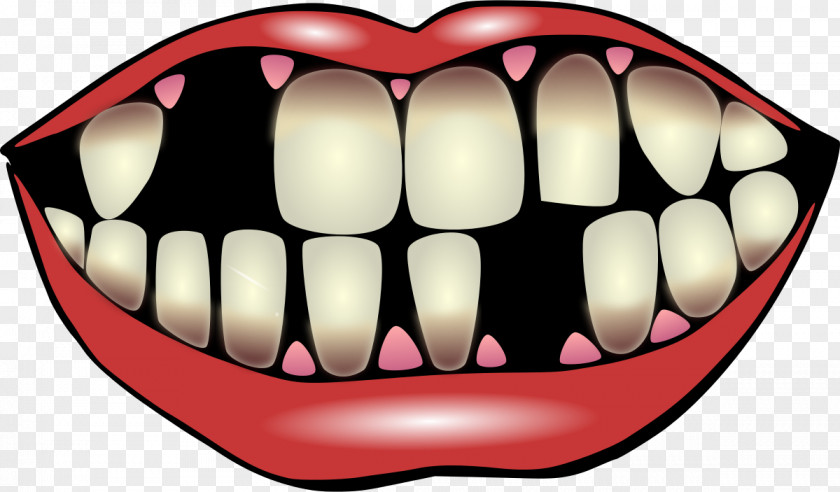 Moini Tooth Pathology Dentistry Clip Art PNG
