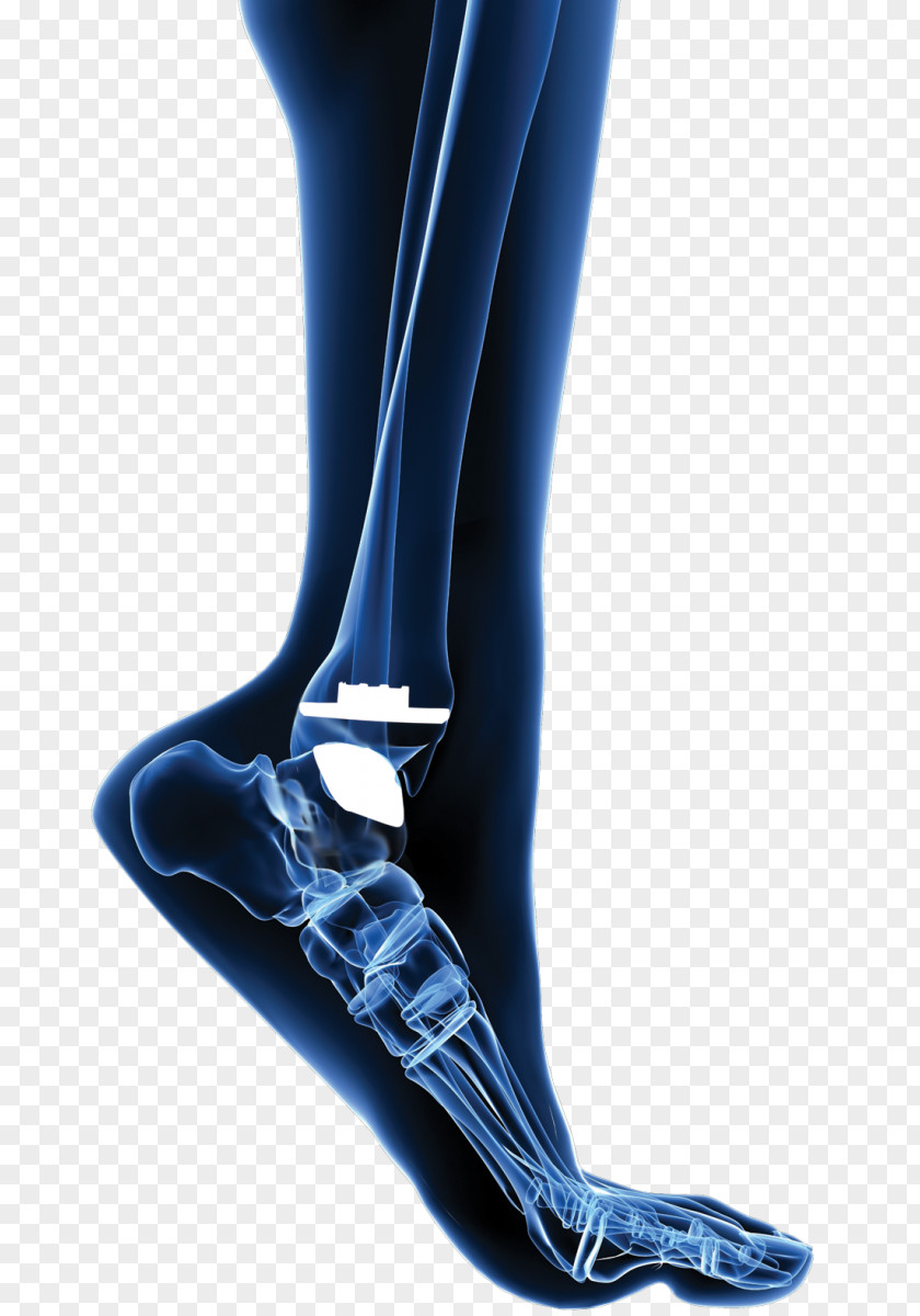 Joint Total Ankle Arthroplasty Replacement PNG