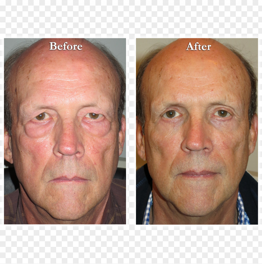 Double-fold Eyelids Eyebrow Blepharoplasty Eyelid Reconstructive Surgery PNG