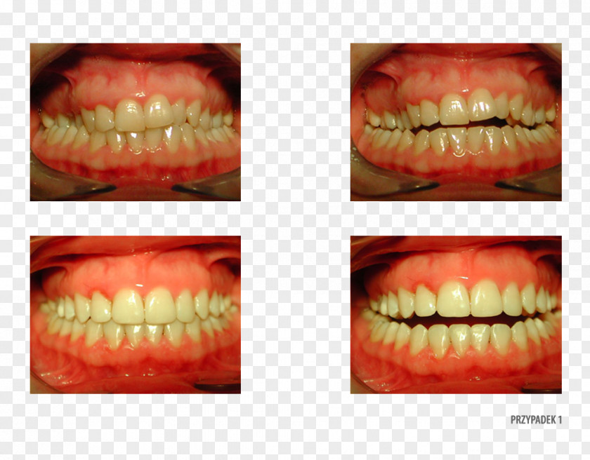 Camera Gums Gingivoplasty Human Tooth Surgery PNG