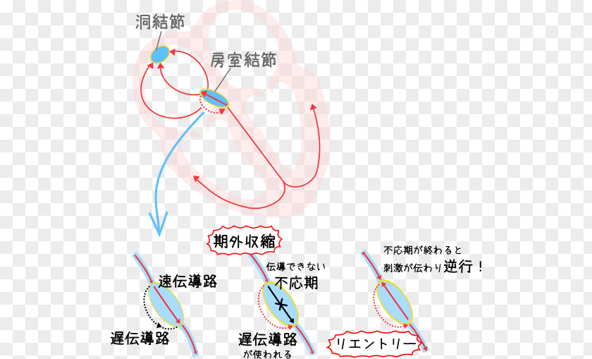 Wpw Ecg Supraventricular Tachycardia Sinoatrial Node Atrioventricular Heart PNG