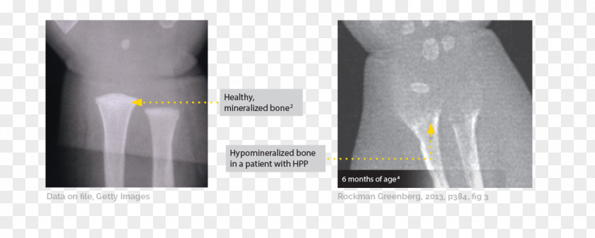Bone Fracture Hypophosphatasia Rickets Osteomalacia Radiology PNG