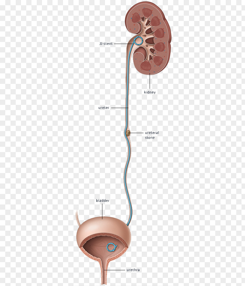 Kidney Stones Ureteric Stent Stenting Excretory System PNG