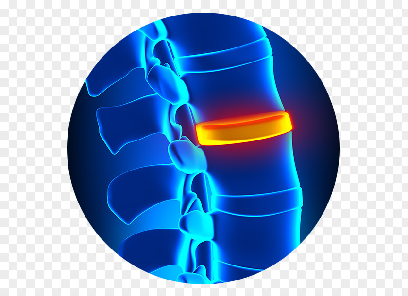 Spinal Disc Herniation Degenerative Disease Vertebral Column Orthopedic Surgery PNG