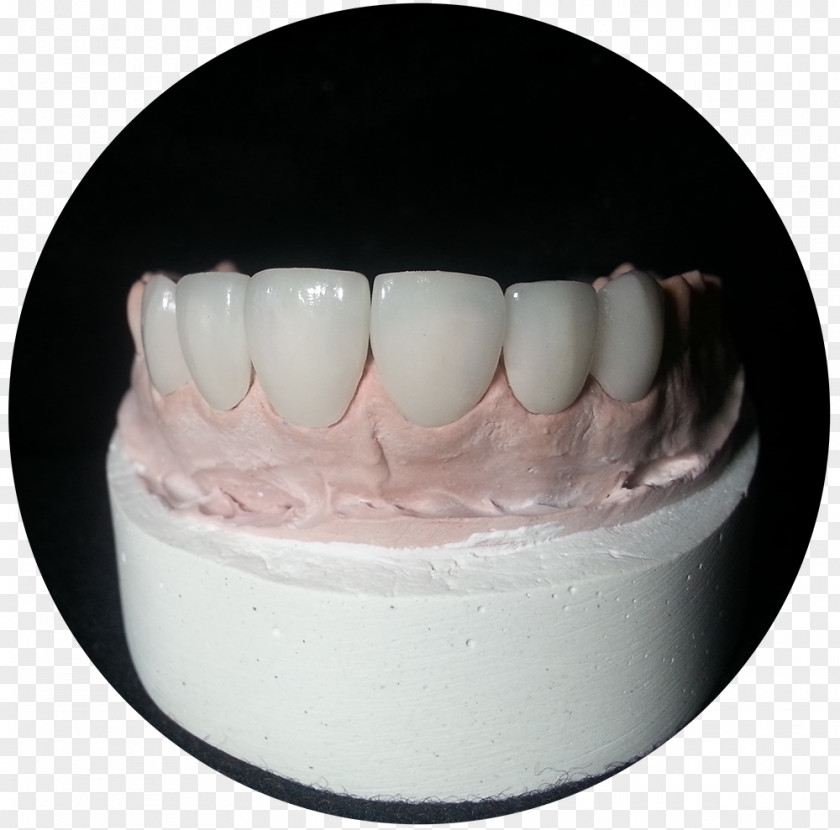Tooth Crown Viax Dental Panamá Glass-ceramic Technology PNG