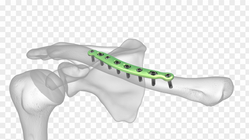 Plate Hole Clavicle Fracture Bone Surgery Internal Fixation PNG