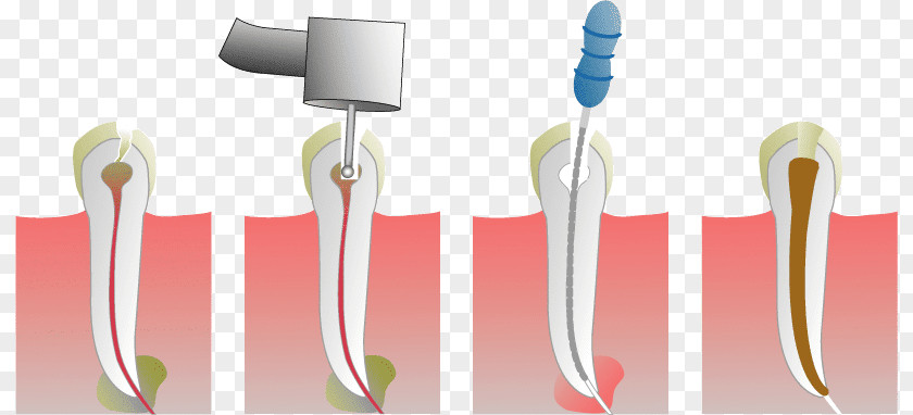 Root Canal Endodontic Therapy Dentistry Medical Procedure PNG