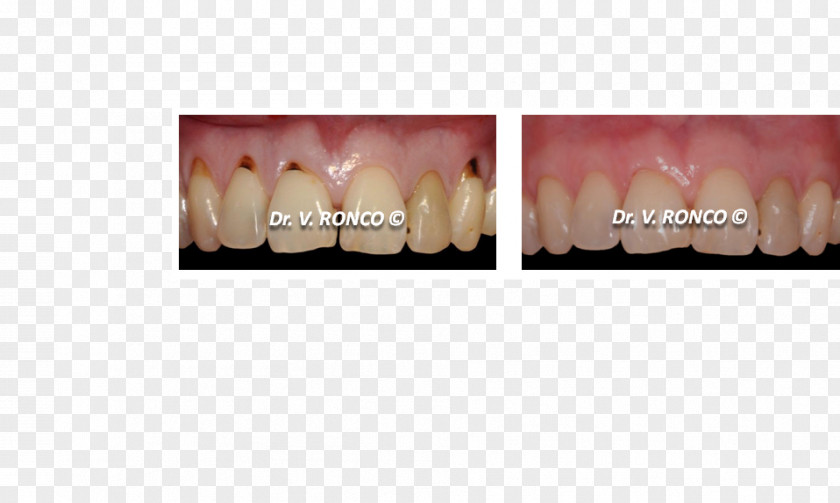 Gingival Tooth Dentist Gums Graft Dental Implant PNG