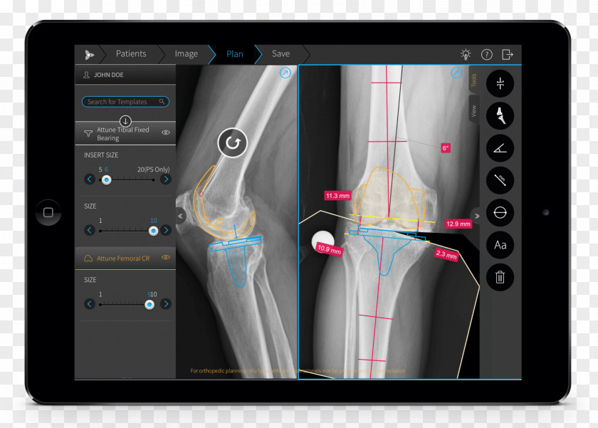Brainlab Orthopedic Surgery Knee Replacement American Academy Of Orthopaedic Surgeons PNG