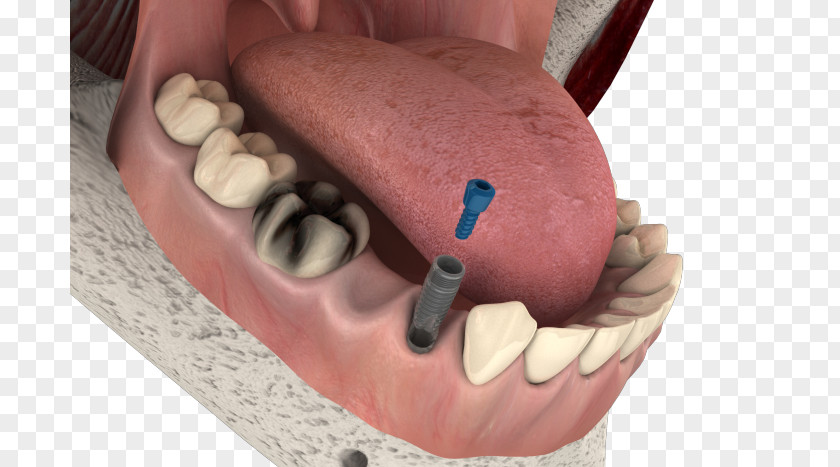 Implants Bridge Dental Implant Dentistry Therapy Tooth PNG