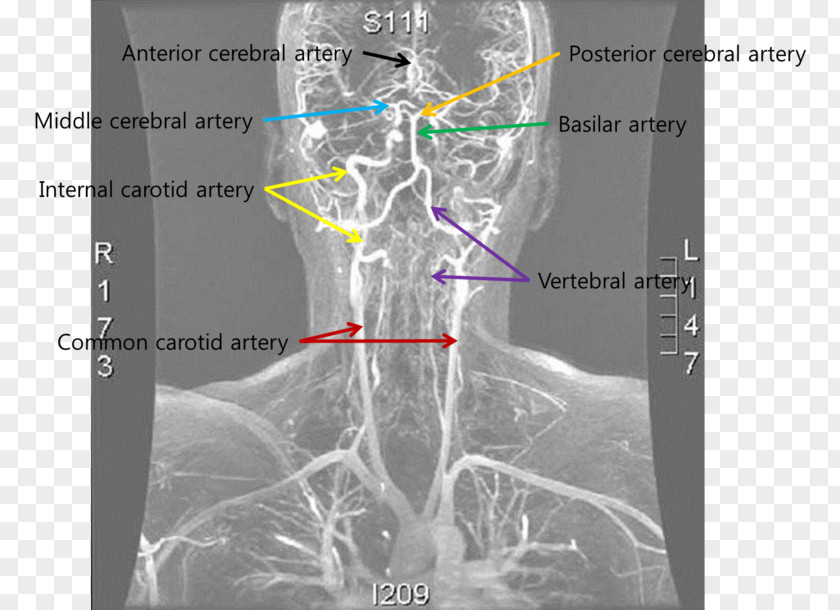 Anterior Cerebral Artery Medical Imaging Vertebral Dissection Blood Vessel PNG
