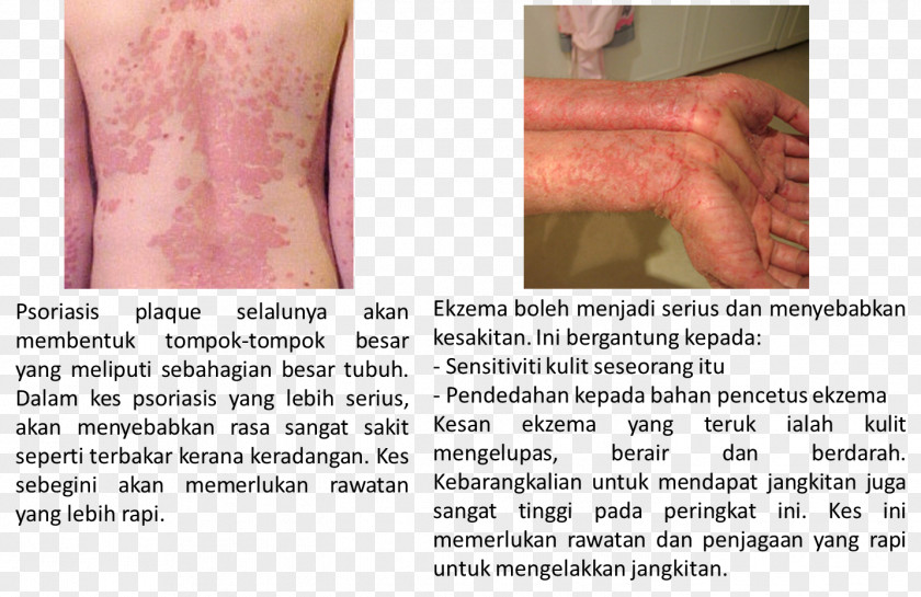 Gandum Thumb Cell Psoriasis Skin Eczema PNG