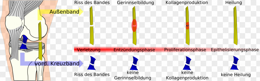 Rupture Kecederaan Ligamen Krusiat Hadapan Anterior Cruciate Ligament Ruptur Kollateralligament PNG